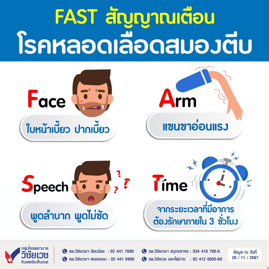 FAST สัญญาณเตือน โรคหลอดเลือดสมองตีบ !!