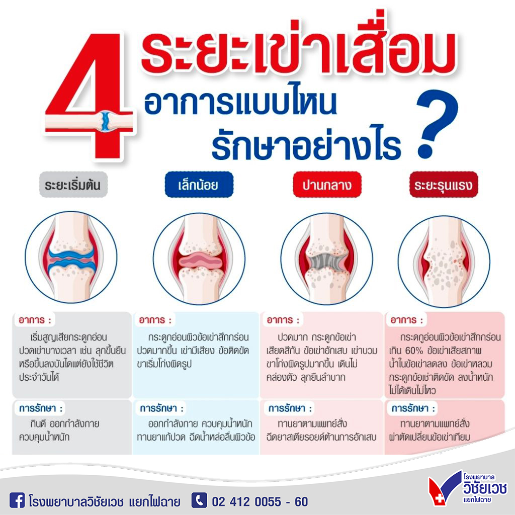 4 ระยะเข่าเสื่อม อาการแบบไหน รักษาอย่างไร?